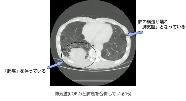 肺気腫(COPD)と肺癌を合併している1例