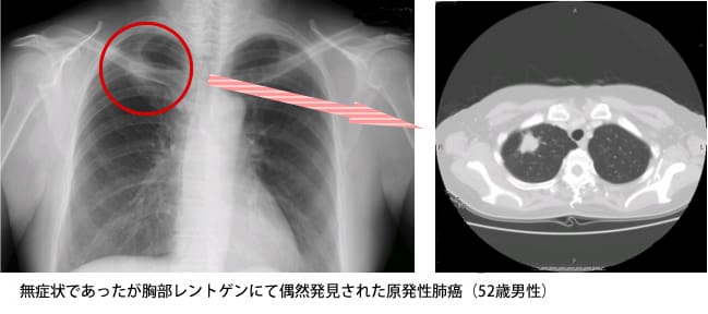 無症状であったが胸部レントゲンにて偶然発見された原発性肺癌